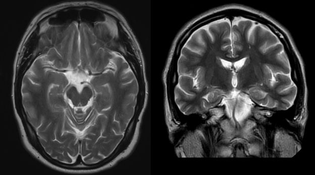 ressonância magnética crânio