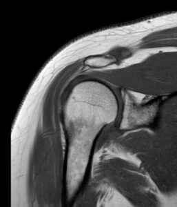 ressonância magnética ao ombro (exemplo)